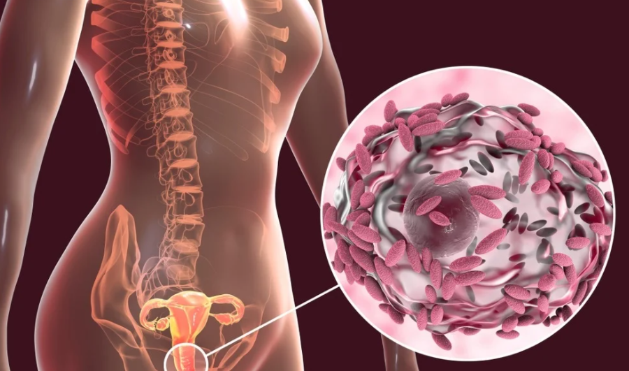 bacterial vaginosis